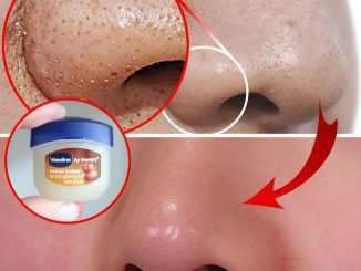 Remove blackheads on your nose with just a mixture of Vaseline and this cheap and easy-to-find ingredient