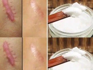 How to Use Coconut Oil to Get Rid of Stretch Marks and Scars Forever